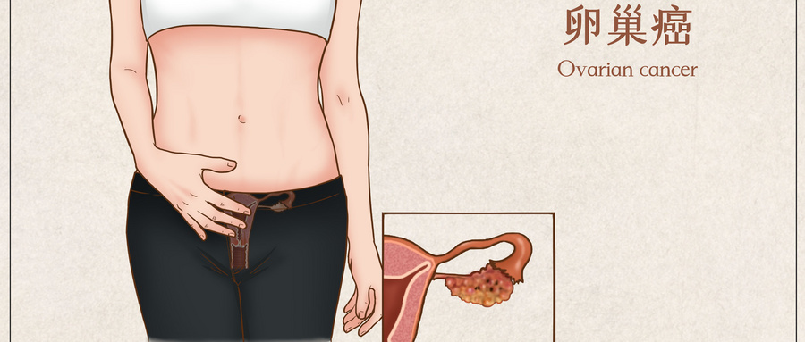 卵巢癌.jpg